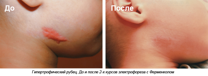 Гипертрофический рубец. До и после 2-х курсов электрофореза с Ферменколом