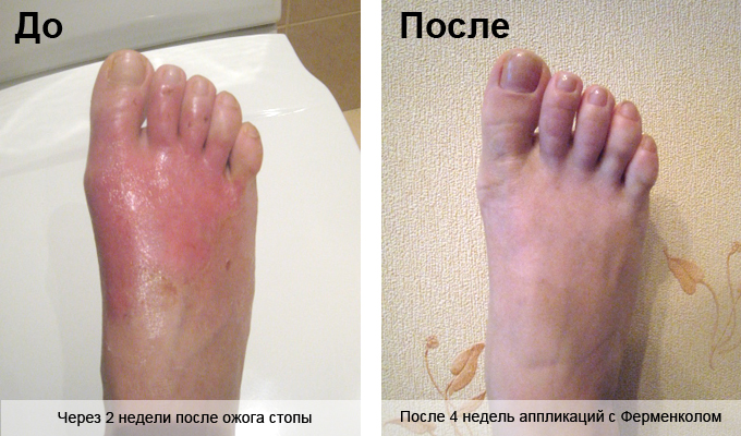 До и после 4 недель аппликаций с Ферменколом. Профилактика рубцов